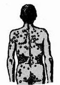 A possible scheme of infection