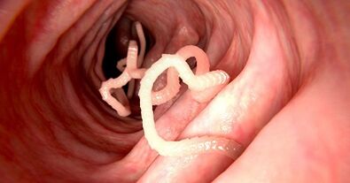 The cause of parasites in the human body