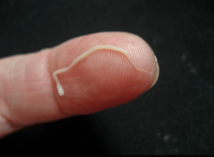 roundworm parasite from the human body